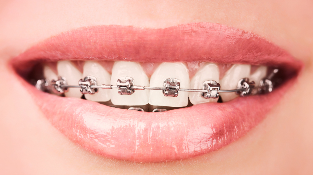 Feste Zahnspangen mit Metallbrackets