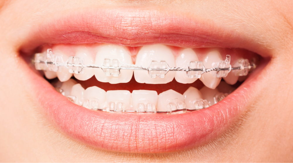 Feste Zahnspangen mit Keramikbrackets